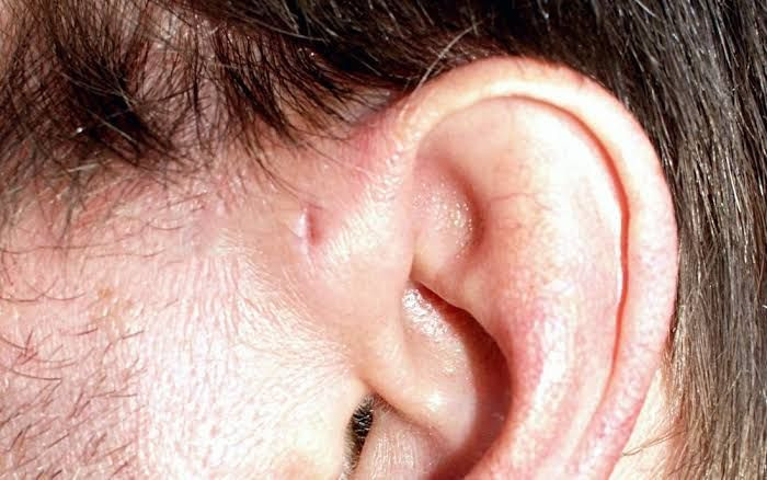 Lubang kecil di telinga